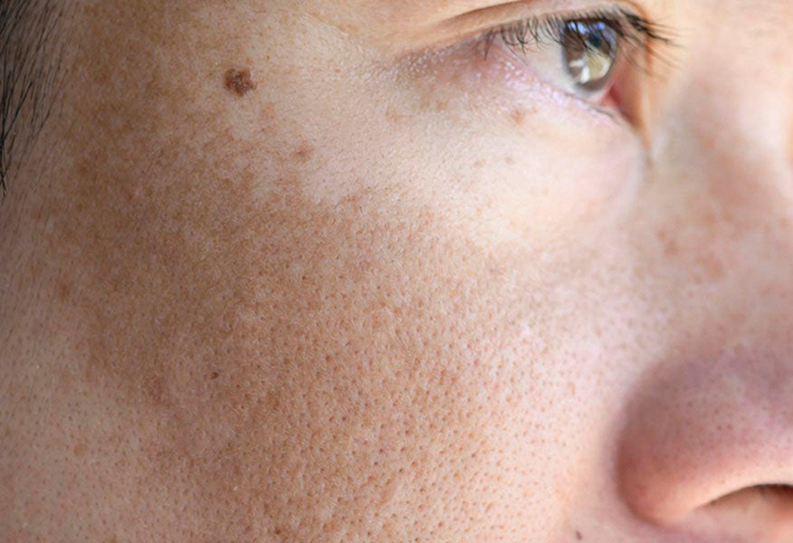 Dermamelan ārstēšana