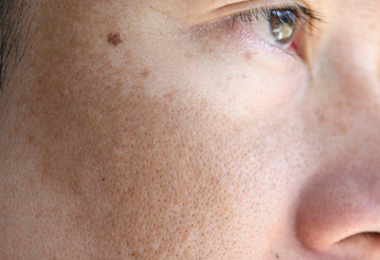 Dermamelan treatment